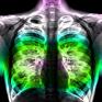 Pneumonia